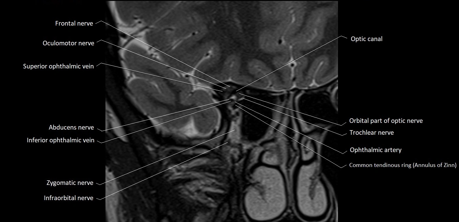 MRI Orbit coronal cross sectional anatomy image 15.webp